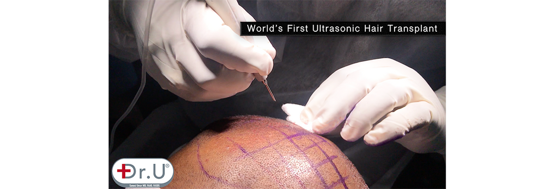 ugraft sonic fue by dr u