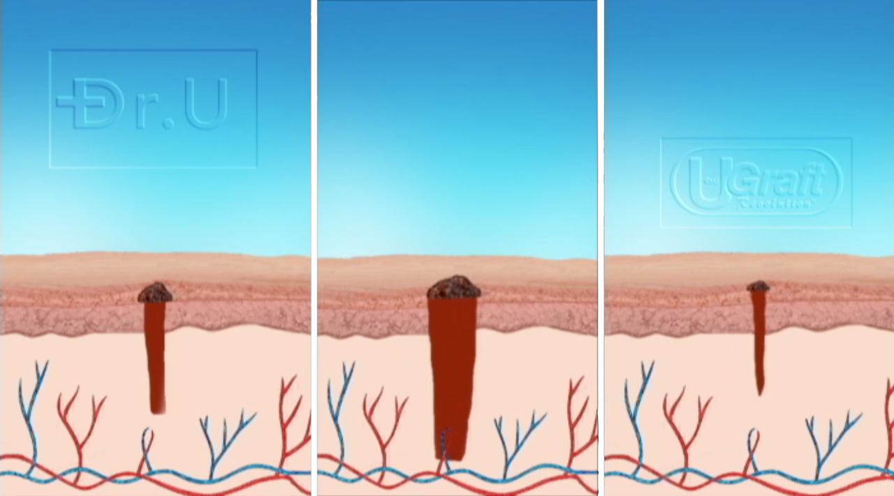 Choosing Dr.UGraft For Better Linear Scar Free Hair Transplant Donor Wound Healing The Dr