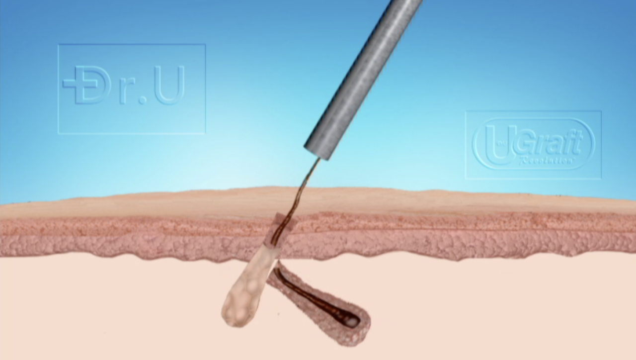 Conventional punches often fail to safely extract body hair due to the angled growth underneath the skin, resulting in transection. The Intelligent Punch™ (Dr.UPunch i™) avoids this through several key features, including its uniquely flared tip and graft grip, pull, score, and release mechanisms.