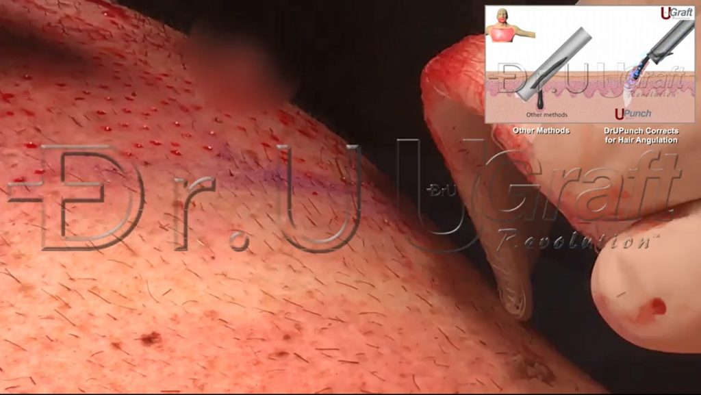 Dr.UGraft's flared hair transplant punch corrects for misalignment issues with sharply angled chest hair, which is otherwise highly susceptible to damage with regular hair transplant punches.