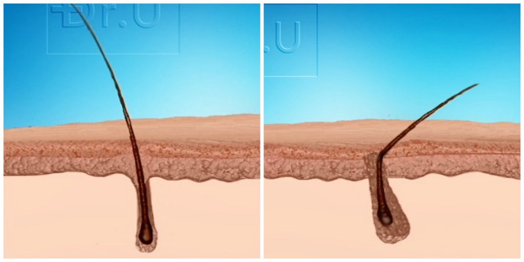 Side by side comparison of different types of hair exit angles in the skin. Left image depicts typical head hair which grows close to 90 degrees. Right image shows the sharp angle bend of non-head hair, typically found on various regions of the body. 