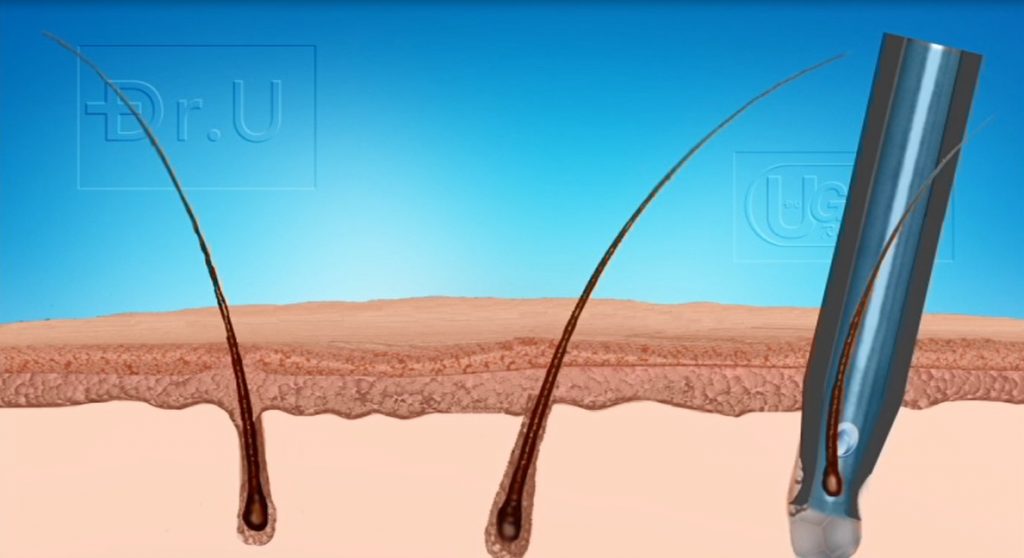 The patented upward pulling feature helps to overcome hair transplant problems from graft angulation issues. The fluid irrigation facilitates the graft's ascent into the punch by lubricating the inner metal surface. 
