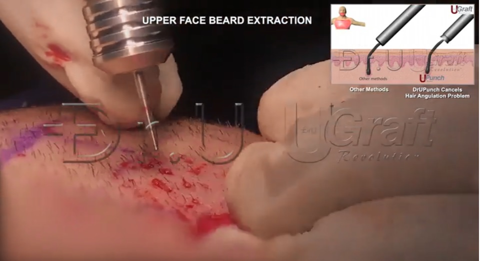 Dr.UGraft solves hair transplant problems from graft angulation issues with a patented textured feature, instead of a smoother inner lining allowing it to automatically navigate the course of any hair angle