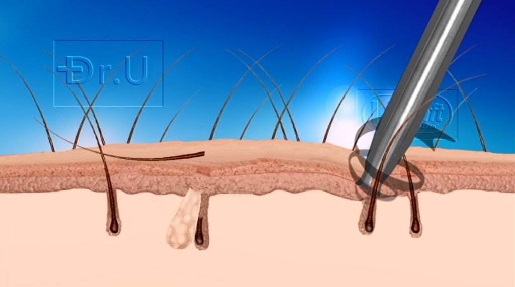 Poor hair transplant growth from graft misalignment injuries is very likely due to extractions in highly moveable regions like the abdomen. Dr. UGraft punches is able to prevent these types of damage on softer, mobile body surfaces. 