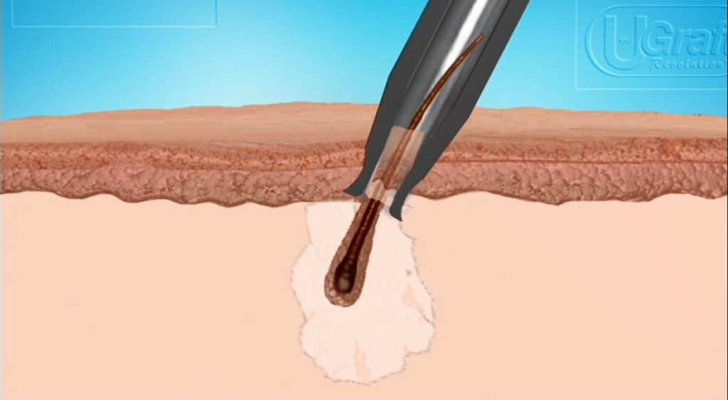 Dr.UGraft Enables Shallow Depth For Extracting Follicles