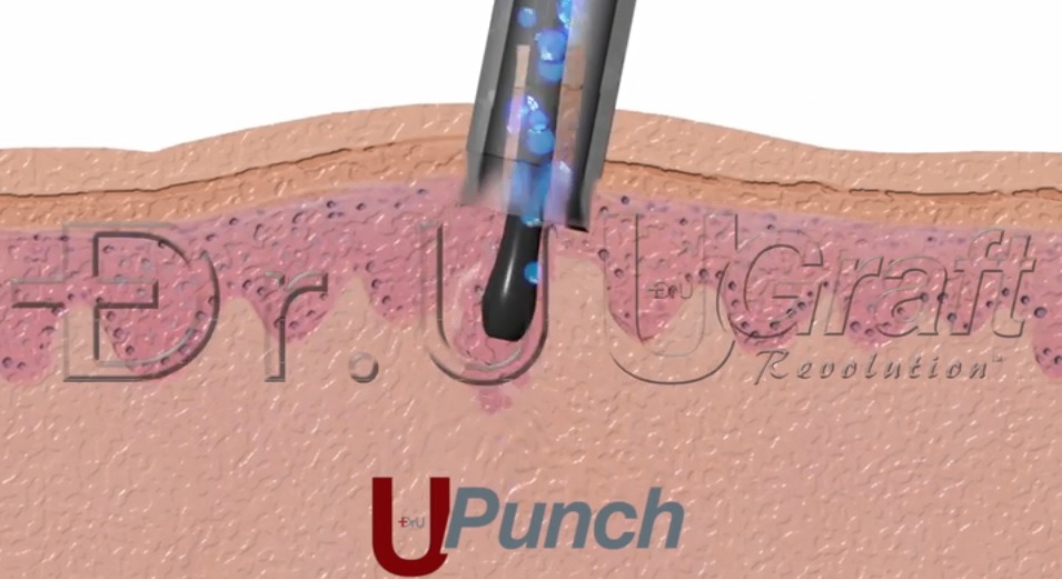 With patented texturing, the Dr.UGraft rotary device is able to exert a grip around the tissue that surrounds the follicle to pull it up as it is being scored, preventing low hair transplant growth from graft torsion injuries