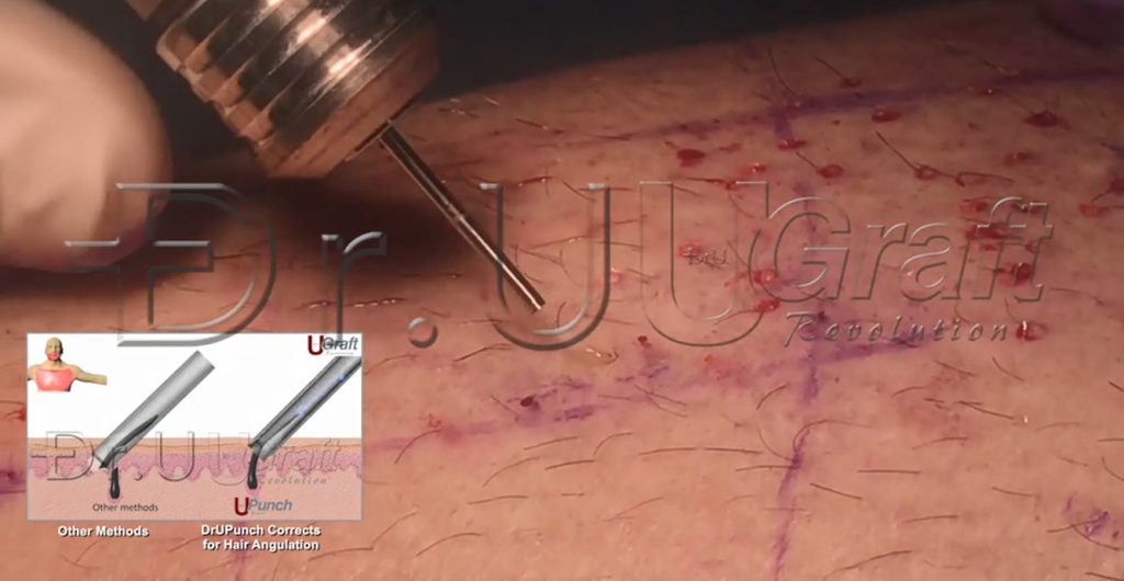 Dr.UGraft™ hair transplant surgery performed on the thighs, where hairs are so sharply angled they are practically parallel to the skin.. The rotary device is still able to auto-correct for this extreme angulation