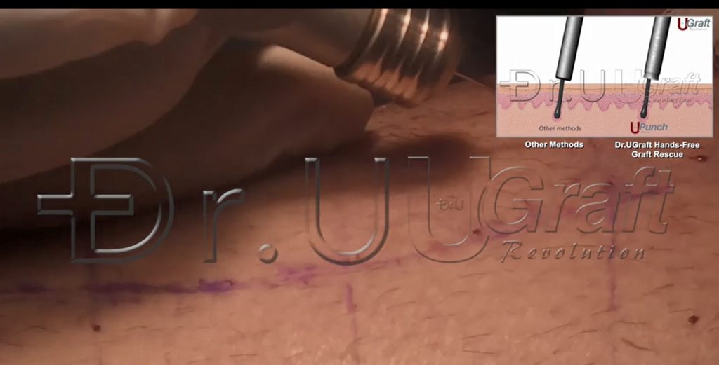 wideness of follicular units for fuller hair transplant coverage