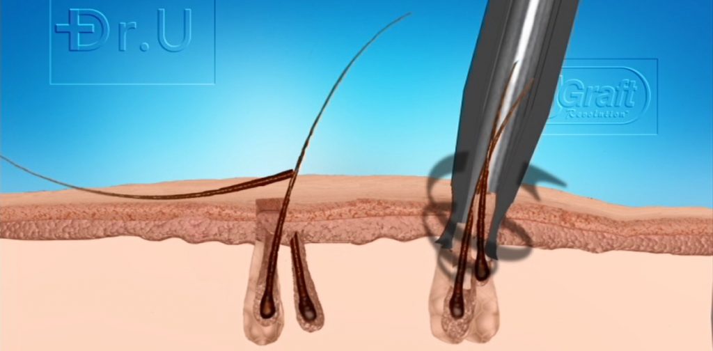 The Dr.UGraft device is designed for successfully extracting multiple hairs in one follicle.