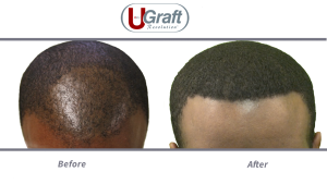 African American patient with hair loss due to childhood accident gets a hairline restoration with advanced Dr.UGraft technology.
