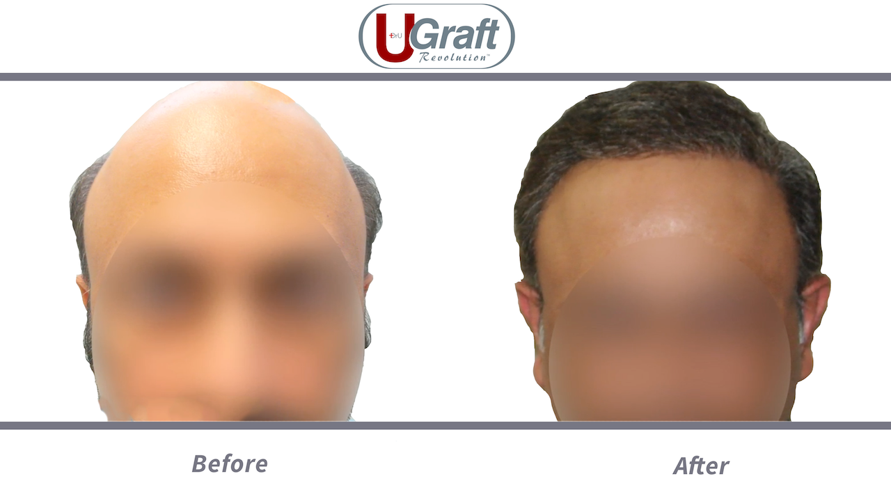 High Dense Hair Transplant Result  NW Grade 3 Baldness  2800 Grafts    High Dense Hair Transplant Result  NW Grade 3 Baldness  2800 Grafts    For More Details  India 919325558888 Bangladesh   By New Roots Hair Transplant 