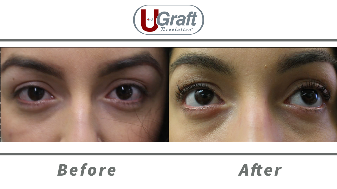 Patient 6 months after her cosmetic eyelash transplant. Roughly 30 follicles were grafted onto each upper eyelid using specialized needles.