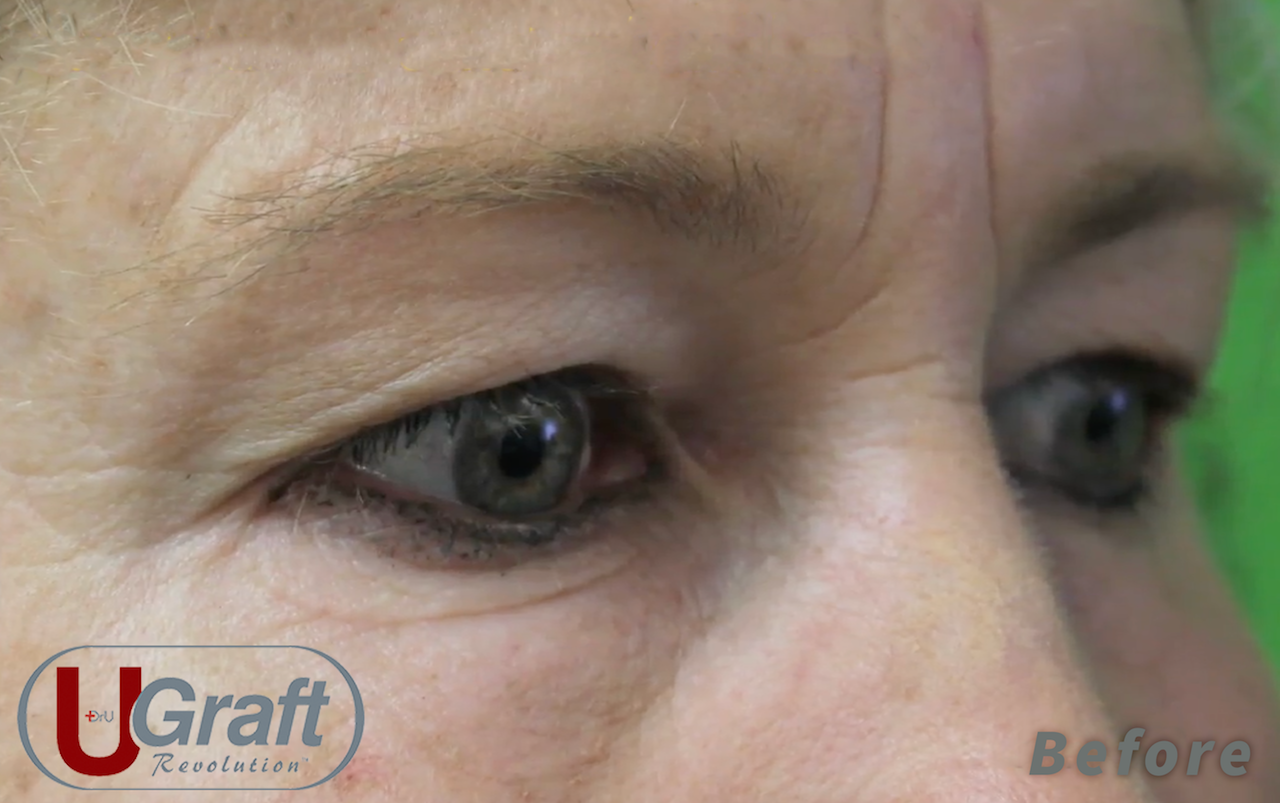 This patient sought a permanent solution for her sparse eyebrows. She chose Dr.UGraft for her eyebrow transplant procedure, inspired by a celebrity she admires.