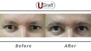 Frontal view of the patient before and after his eyebrow transplant procedure using leg hair.