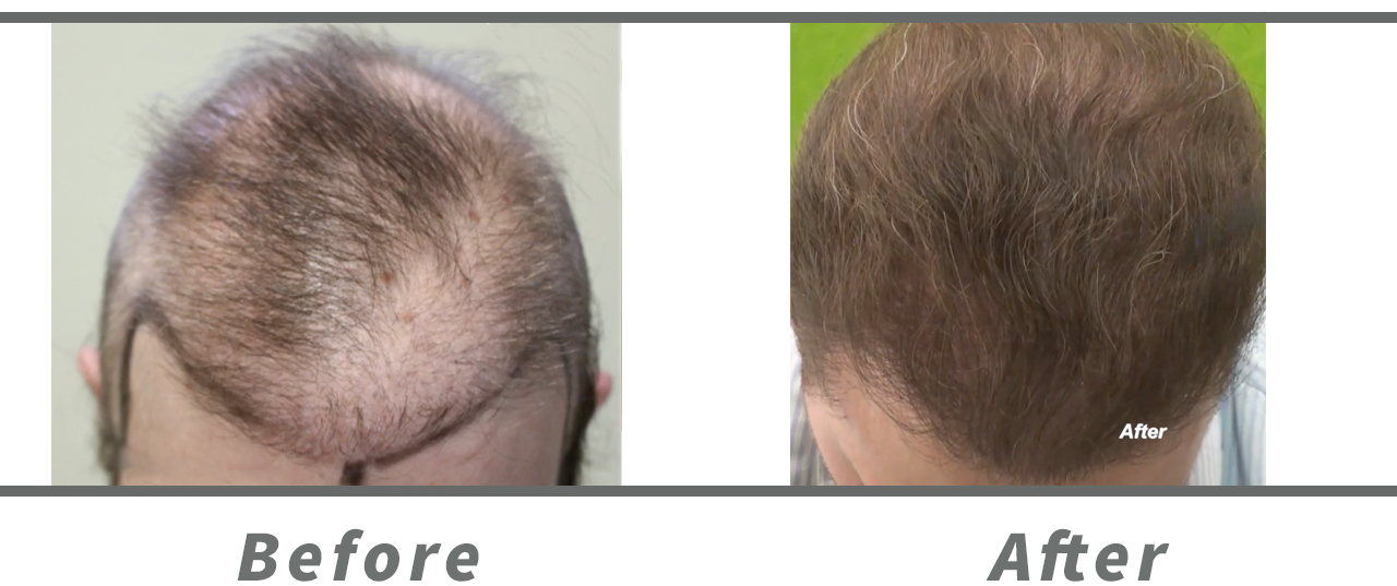A view of the top of the patient's head before and after his hair transplant repair poor growth correction.