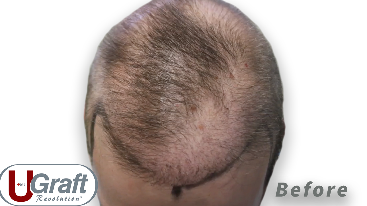 View of the top of the patient's head before his hair transplant repair poor growth correction. Odd patterns of balding can be seen.