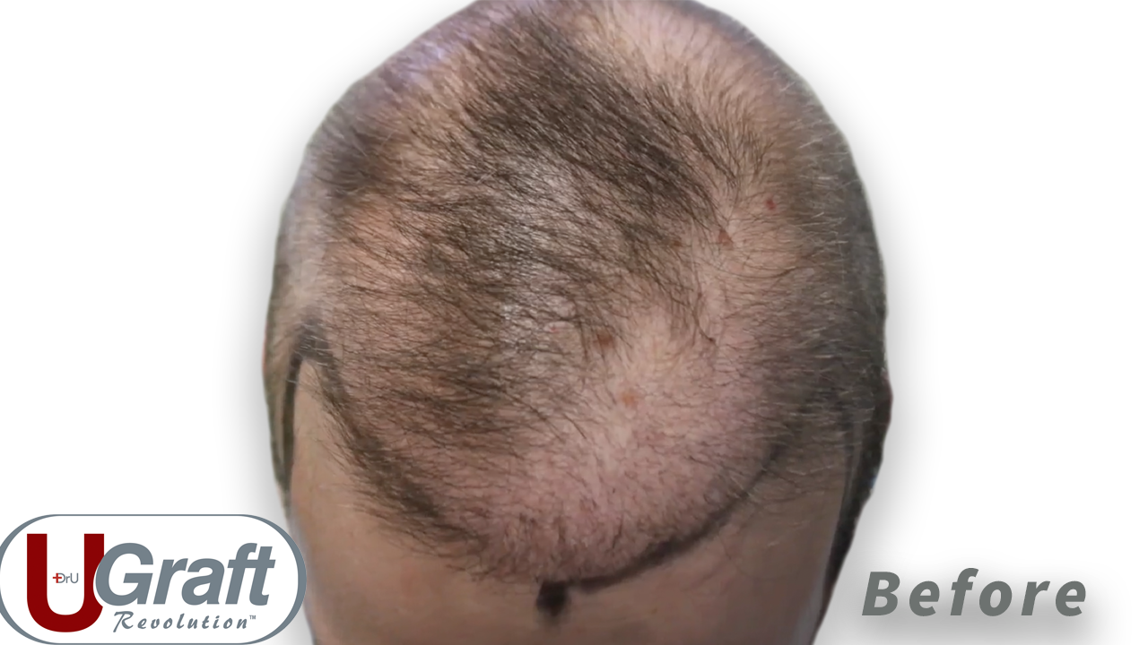 A Guide to High Density Hair Transplantation  Hair Transplant Specialists   Treatment Rooms London