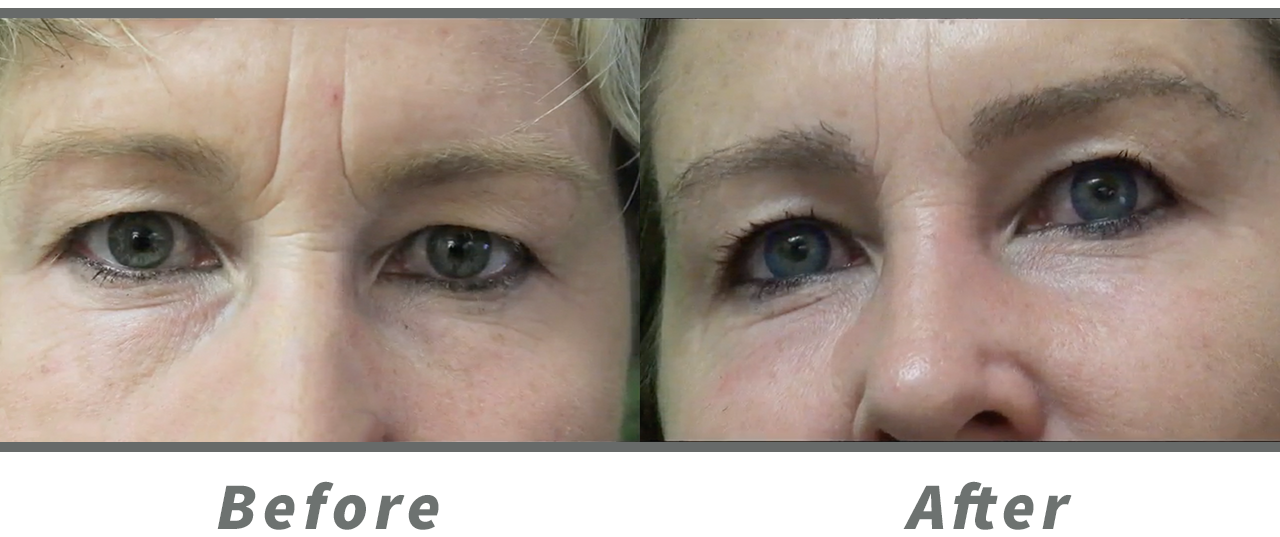 This patient received an eyebrow transplant using nape hair with the Dr.UGraft System.