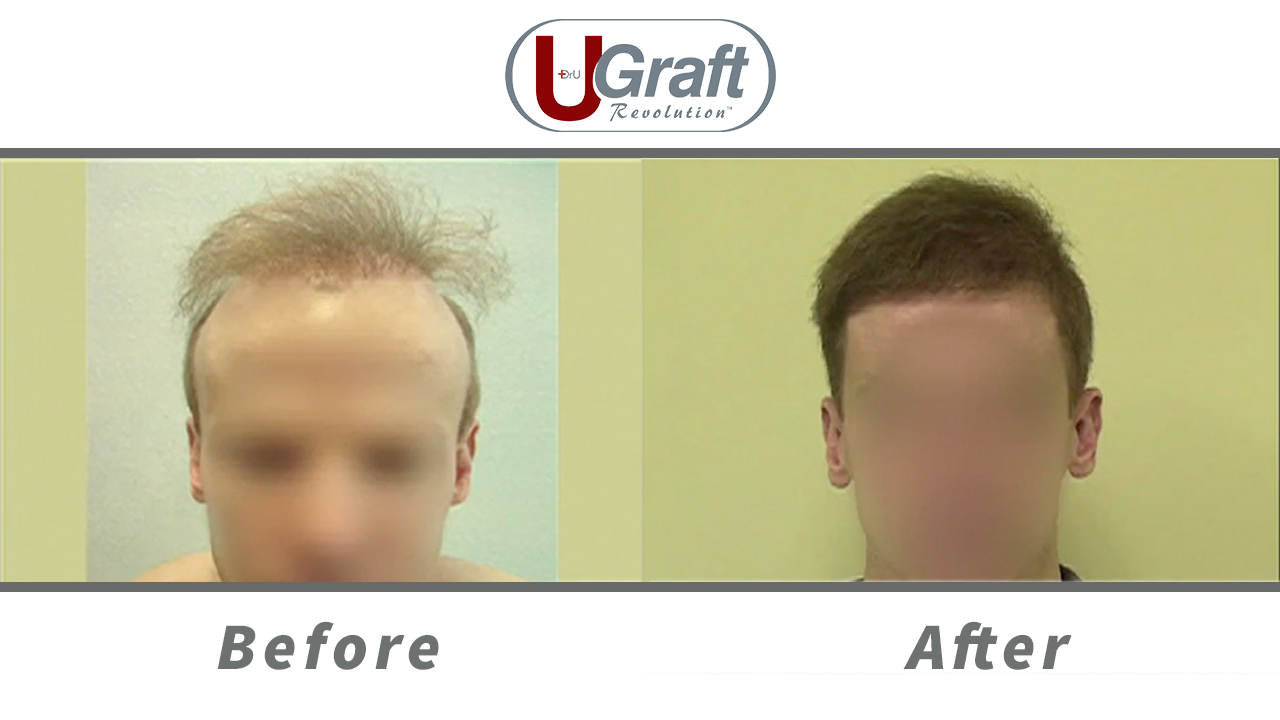 The Dr.UGraft System allowed this patient to achieve coverage and repair his hair transplant scars from previous surgeries.