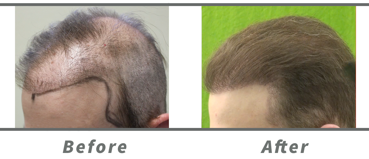 The Dr.UGraft System helped this patient correct poor growth after previous hair transplant at other clinics.