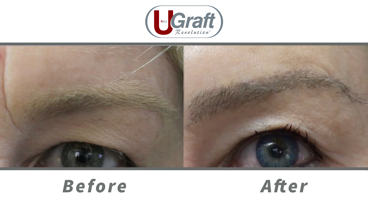 A close up view of the patient before and after her eyebrow transplant using nape hair.