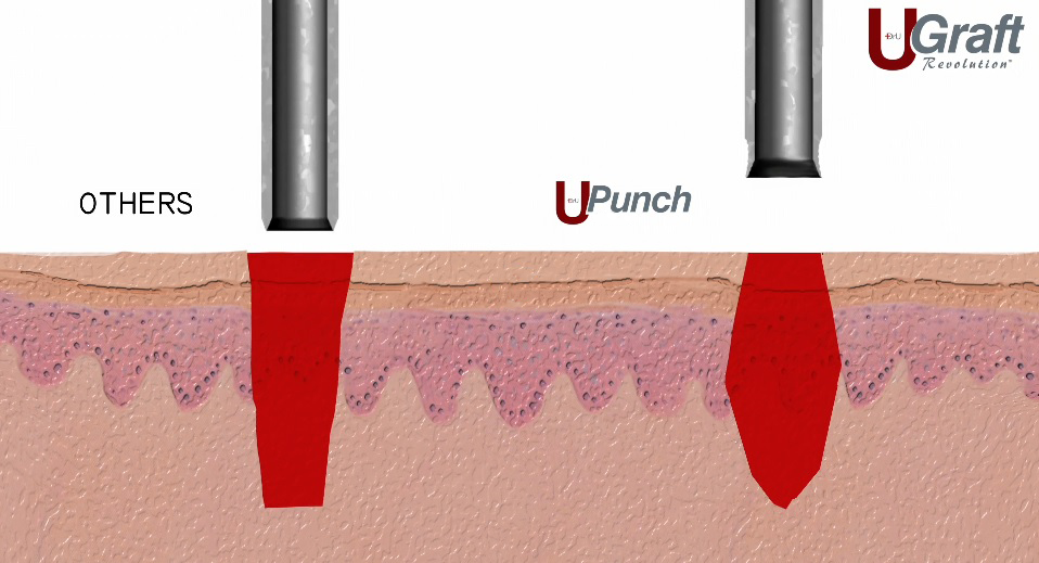 The everted wound profile typically enables non-linear hair transplant scars to heal smaller and flatter.