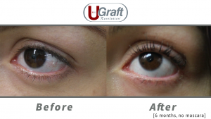 Close up view of the patient before and 6 months after her eyelash transplant using leg hair.