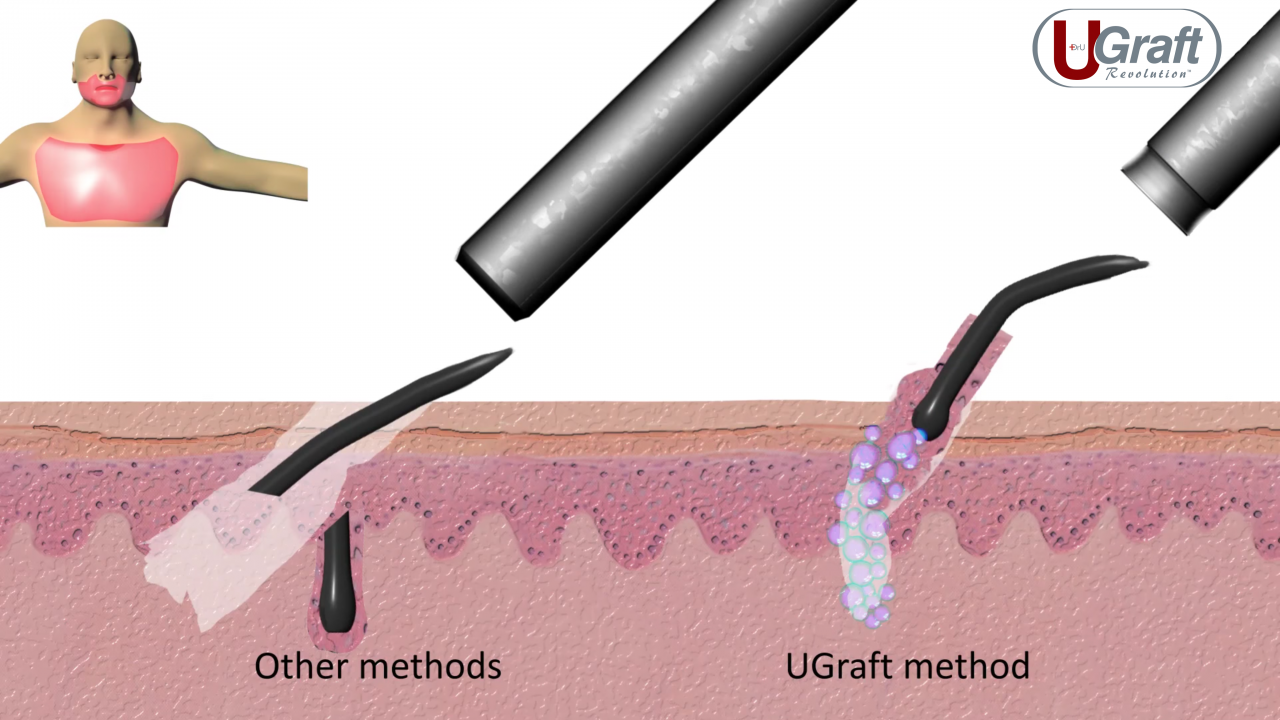 The flared tip of the Dr.UPunch i™, combined with fluid irrigation from the Dr.UGraft™ System, enables safe extraction of angled body hair growth.