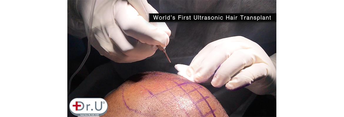 Coming Soon – Dr.UGraft™ Sonic FUE