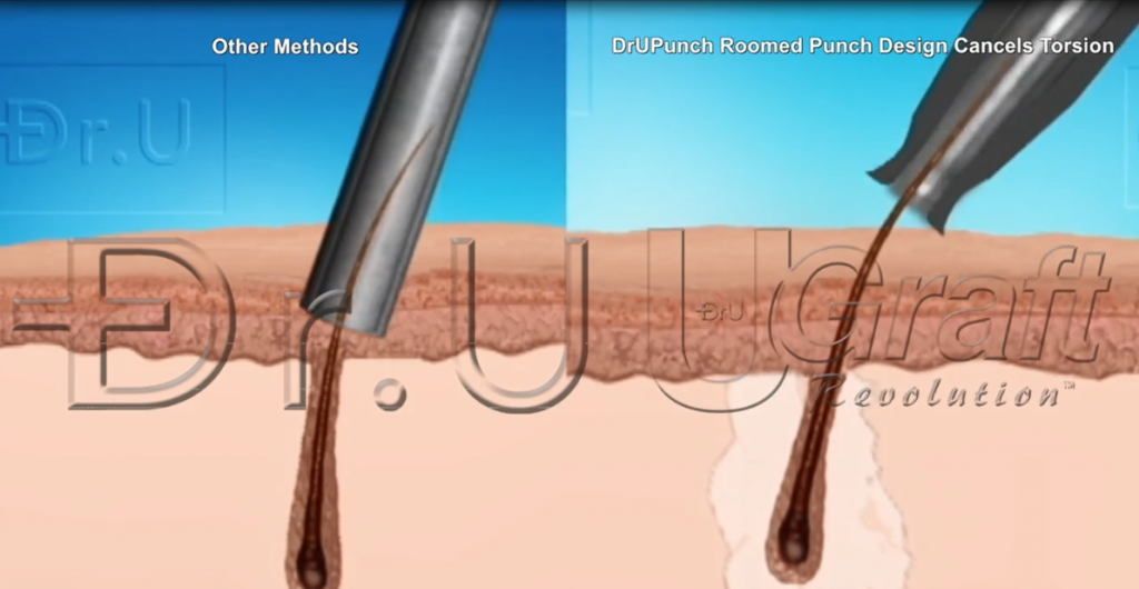 The Dr.UPunch™ gently pulls grafts upward and separates them from their neighboring attachments.