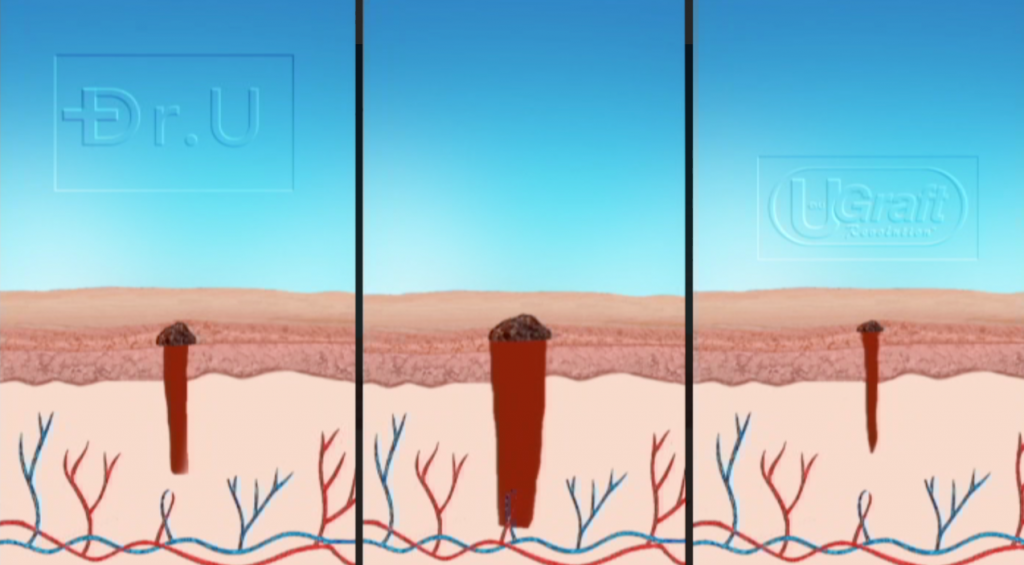 The wound profiles left behind by other FUE punches (left, middle) tend to remain round and bumpy after healing. The less everted edges created by the Intelligent Punch™ (right) typically result in smaller, flatter scars in the donor area.
